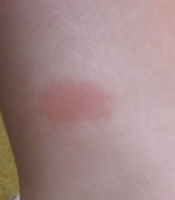 faint-bullseye-rash - Debug Your Health