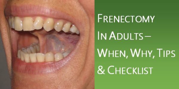 Frenectomy in Adults