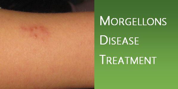 Morgellons Disease Treatment