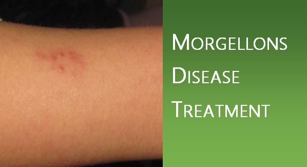 Morgellons Disease Treatment