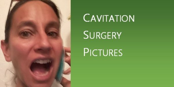 Cavitation Surgery Pictures