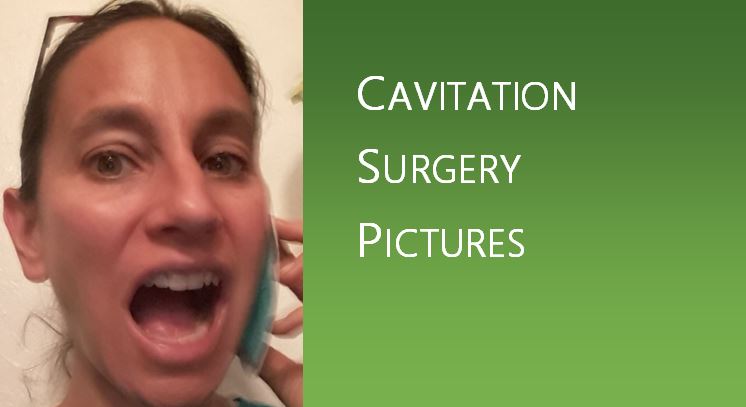 Cavitation Surgery Pictures