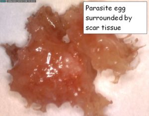 Parasite Egg Surrounded by Scar Tissue